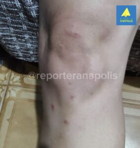 MULHER É AGREDIDA COM CAPACETE E BEBÊ FICA FERIDA DURANTE VIOLÊNCIA DOMÉSTICA EM ANÁPOLIS